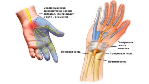 Какие симптомы могут сопровождать невозможность разогнуть пальцы рук после сна. Почему немеют пальцы на одной руке