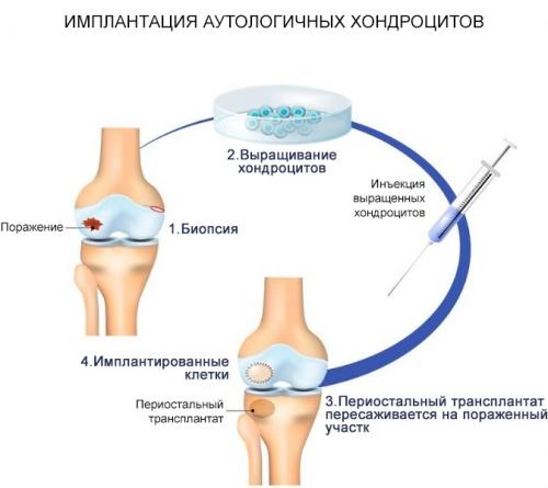 Есть ли современные альтернативы или улучшения этого метода. Методы аутотрансплантации
