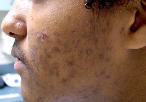 Как убрать пигментные пятна. Пигментация лица: как убрать 04 Как убрать пигментные пятна. Пигментация лица: как убрать 04