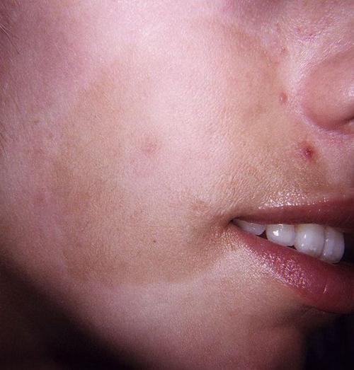 Как убрать пигментные пятна. Пигментация лица: как убрать 07 Как убрать пигментные пятна. Пигментация лица: как убрать 07